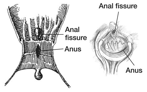 anaal limburg|Anale Fissuur